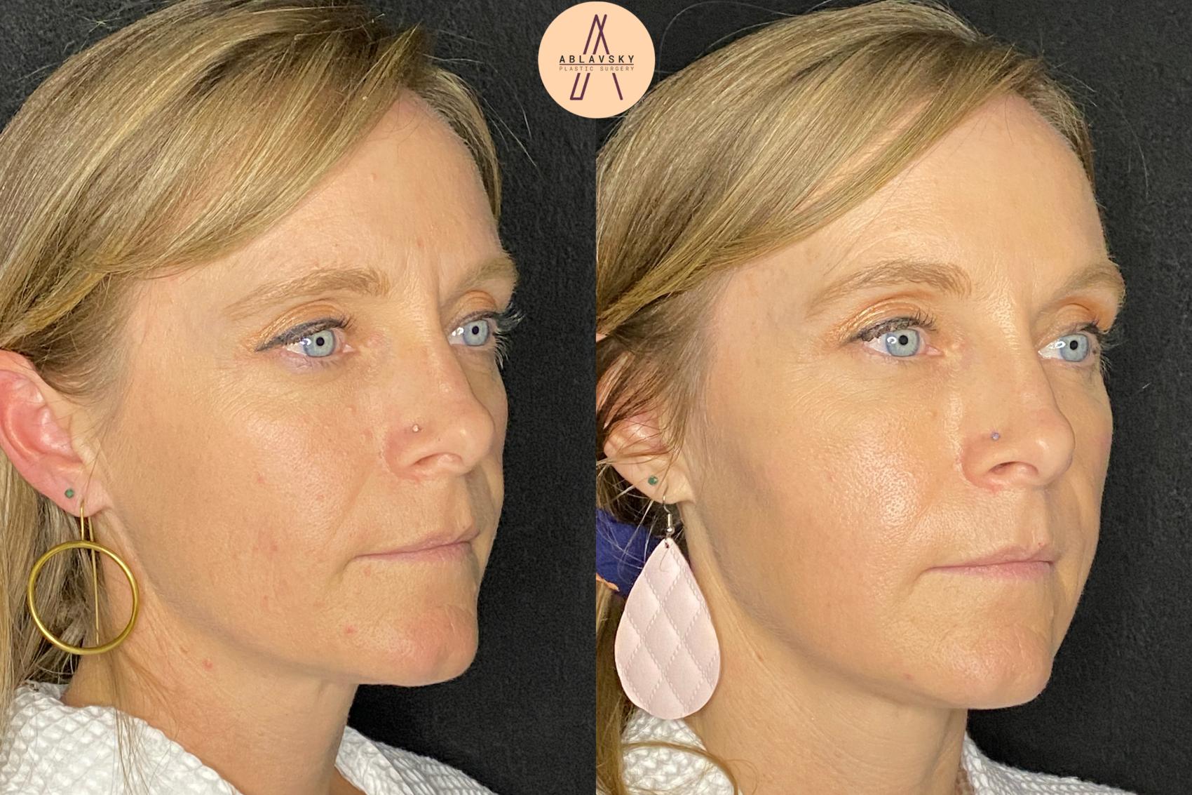 Before & After Facial Fat Grafting Case 51 Right Oblique View in San Antonio, Texas