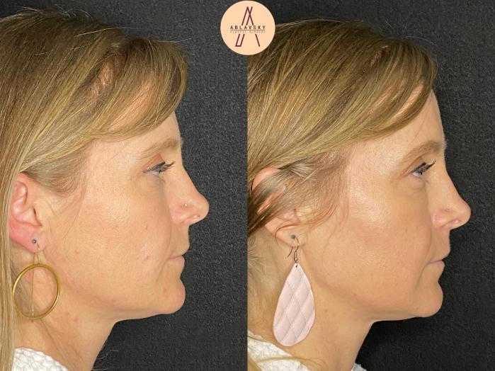 Before & After Facial Fat Grafting Case 51 Right Side View in San Antonio, Texas