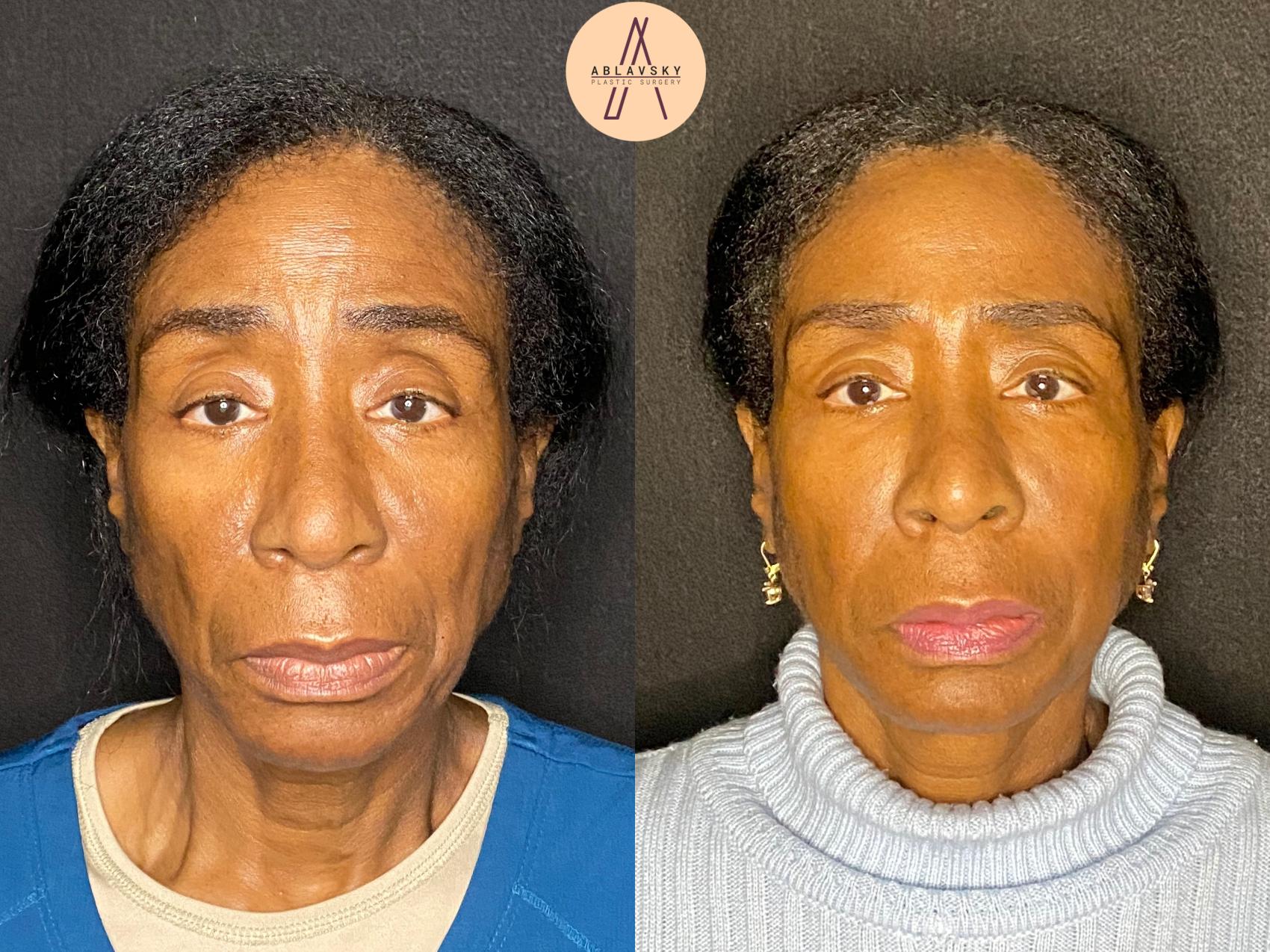 Before & After Facial Fat Grafting Case 74 Front View in San Antonio, Texas