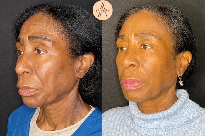 Before & After Facial Fat Grafting Case 74 Left Oblique View in San Antonio, Texas