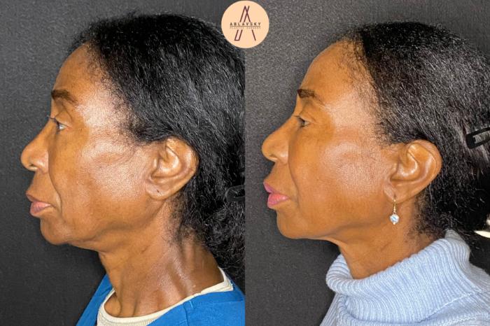 Before & After Facial Fat Grafting Case 74 Left Side View in San Antonio, Texas