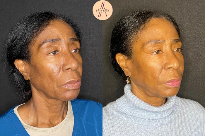 Before & After Facial Fat Grafting Case 74 Right Oblique View in San Antonio, Texas