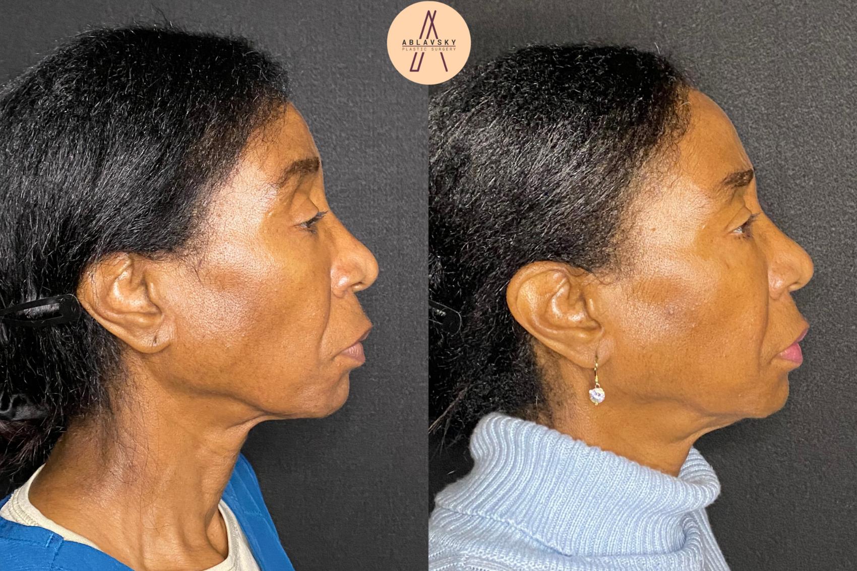 Before & After Facial Fat Grafting Case 74 Right Side View in San Antonio, Texas