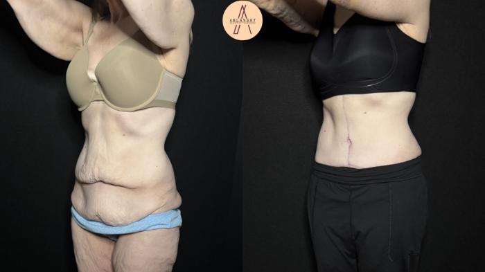 Before & After Fleur-de-Lis Abdominoplasty  Case 315 Left Oblique View in San Antonio, Texas
