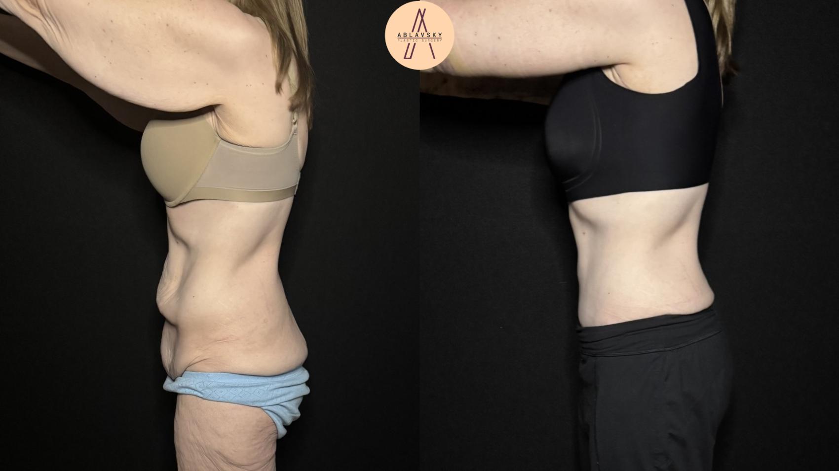 Before & After Tummy Tuck Case 315 Left Side View in San Antonio, Texas