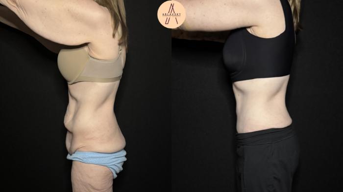 Before & After Fleur-de-Lis Abdominoplasty  Case 315 Left Side View in San Antonio, Texas