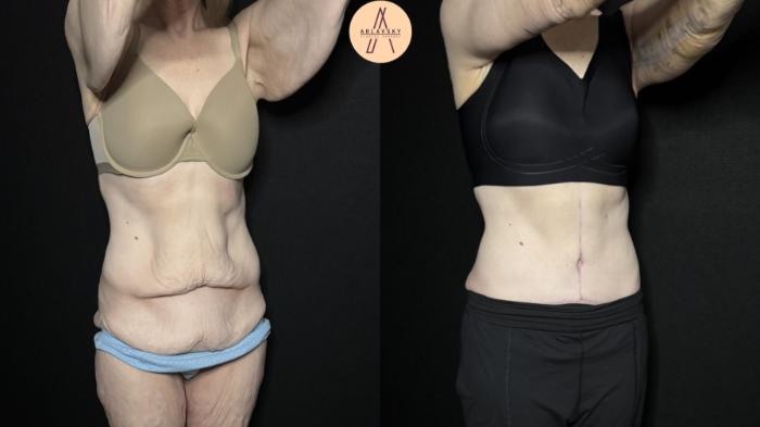 Before & After Fleur-de-Lis Abdominoplasty  Case 315 Right Oblique View in San Antonio, Texas