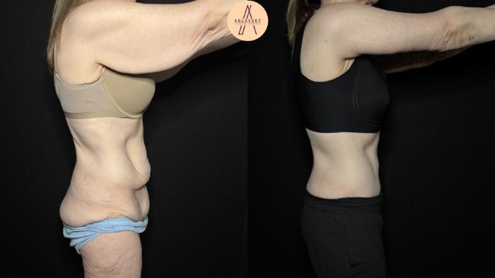 Before & After Fleur-de-Lis Abdominoplasty  Case 315 Right Side View in San Antonio, Texas