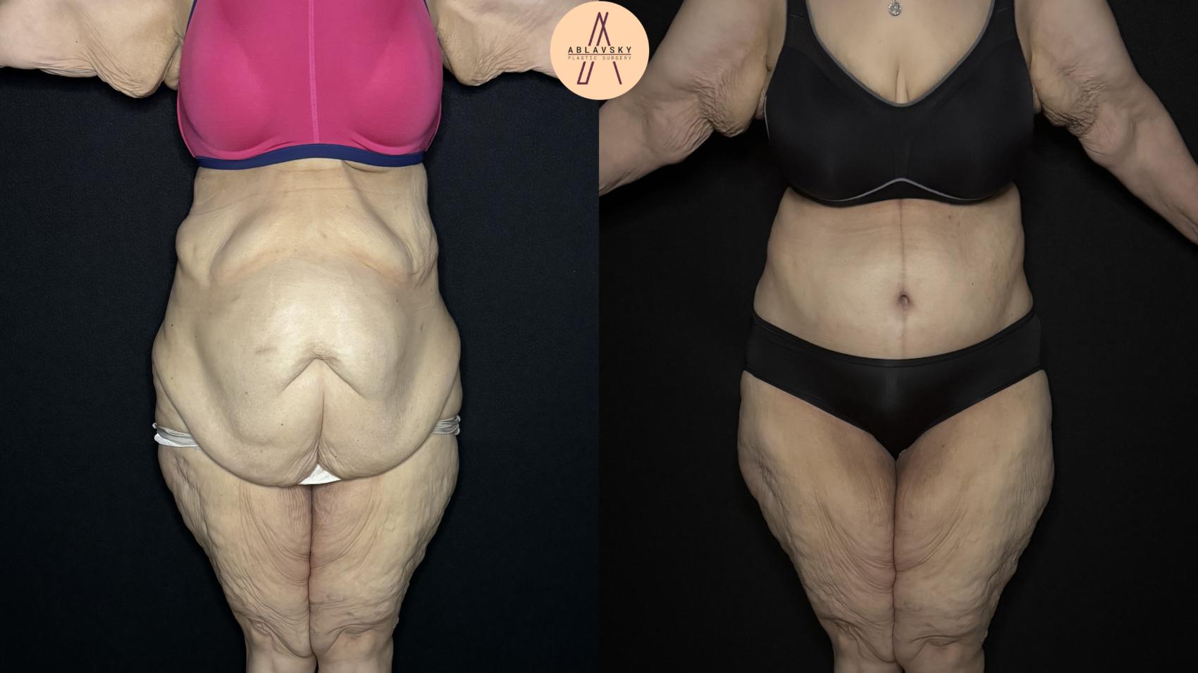 Before & After Fleur-de-Lis Abdominoplasty  Case 334 Front View in San Antonio, Texas