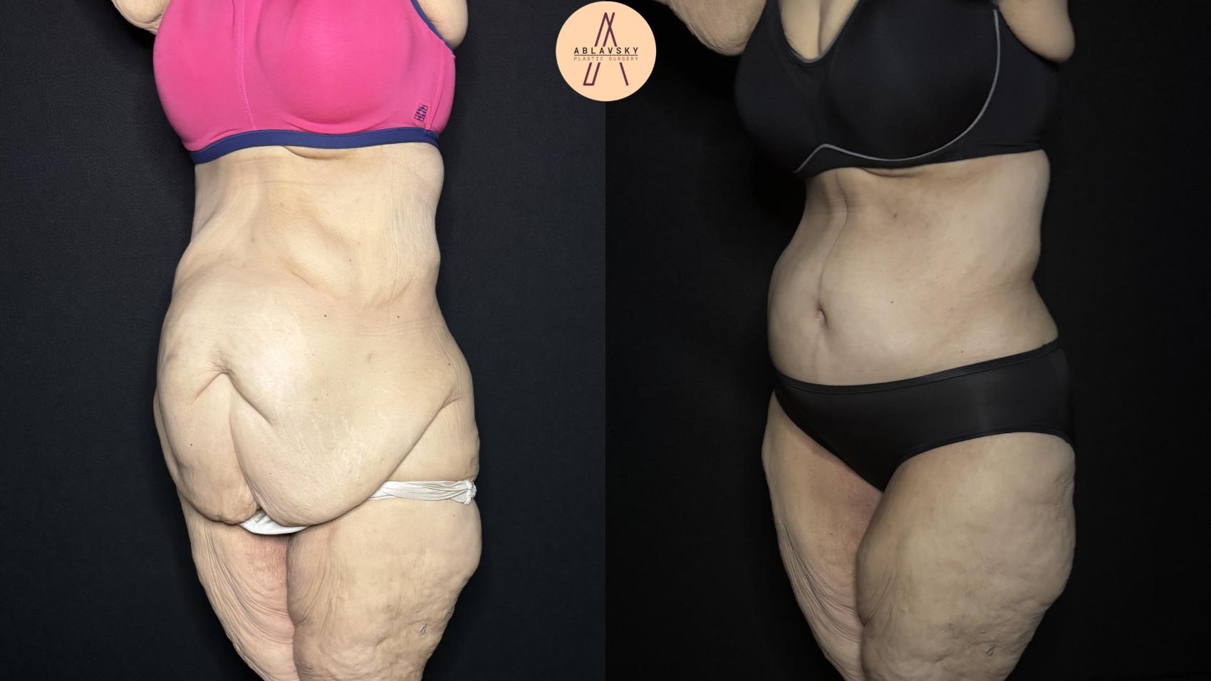 Before & After Fleur-de-Lis Abdominoplasty  Case 334 Left Oblique View in San Antonio, Texas
