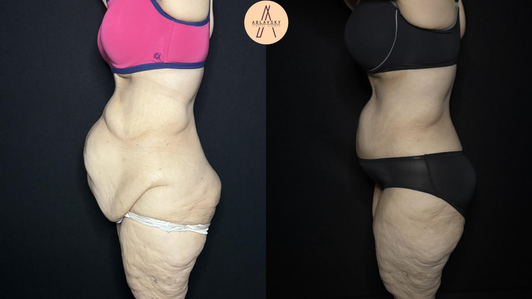 Before & After Fleur-de-Lis Abdominoplasty  Case 334 Left Side View in San Antonio, Texas