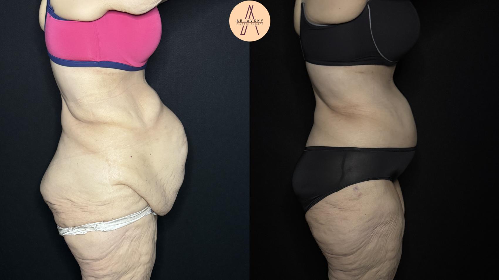 Before & After Fleur-de-Lis Abdominoplasty  Case 334 Right Side View in San Antonio, Texas