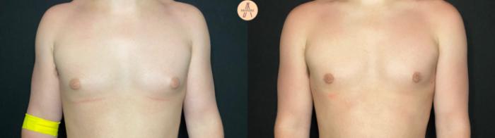 Before & After Gynecomastia Surgery Case 123 Front View in San Antonio, Texas
