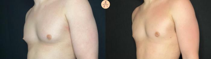 Before & After Gynecomastia Surgery Case 123 Left Oblique View in San Antonio, Texas