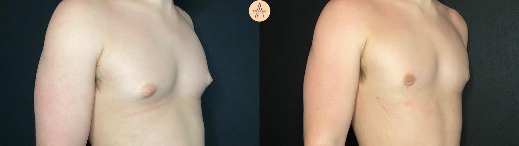 Before & After Gynecomastia Surgery Case 123 Right Oblique View in San Antonio, Texas