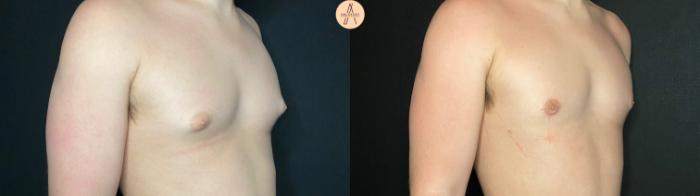 Before & After Gynecomastia Surgery Case 123 Right Oblique View in San Antonio, Texas