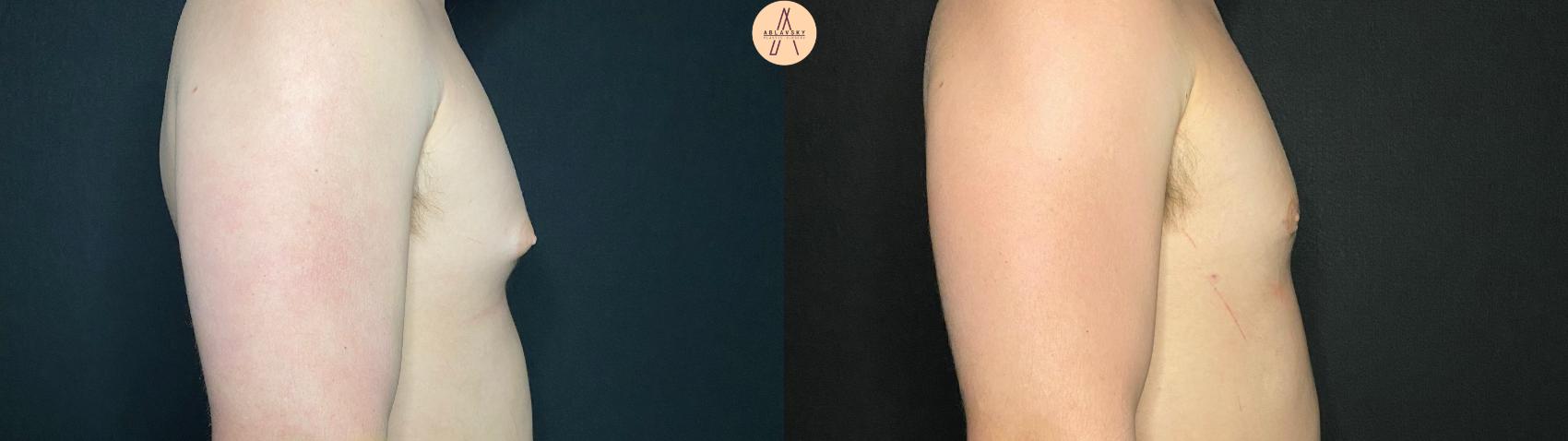 Before & After Gynecomastia Surgery Case 123 Right Side View in San Antonio, Texas