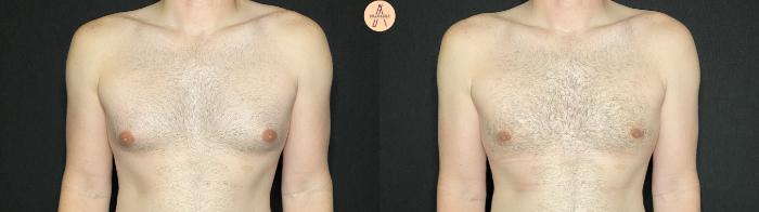 Before & After Gynecomastia Surgery Case 139 Front View in San Antonio, Texas