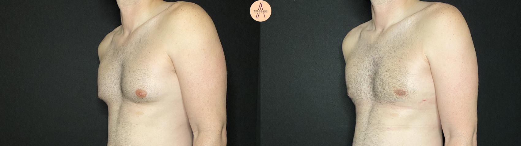 Before & After Liposuction Case 139 Left Oblique View in San Antonio, Texas