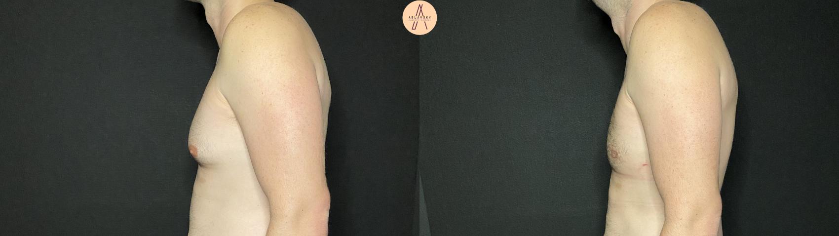 Before & After Liposuction Case 139 Left Side View in San Antonio, Texas