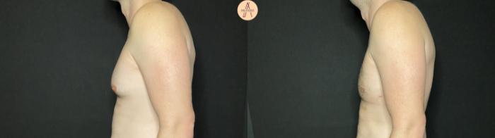 Before & After Gynecomastia Surgery Case 139 Left Side View in San Antonio, Texas
