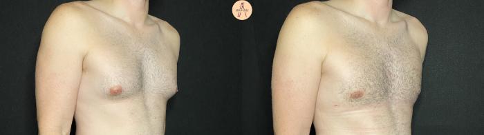Before & After Gynecomastia Surgery Case 139 Right Oblique View in San Antonio, Texas
