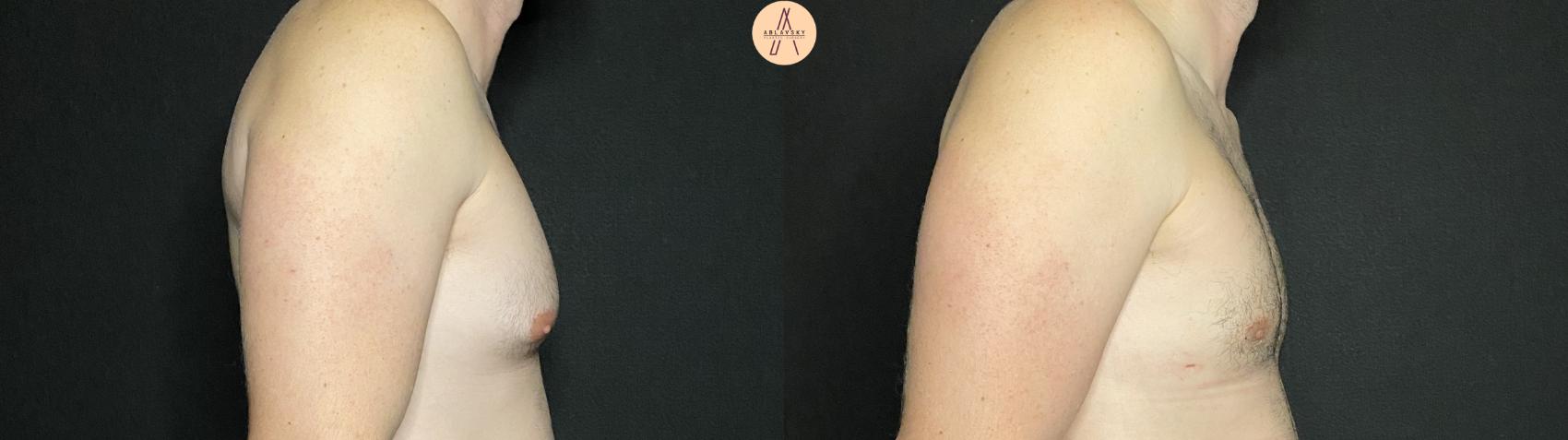 Before & After Liposuction Case 139 Right Side View in San Antonio, Texas