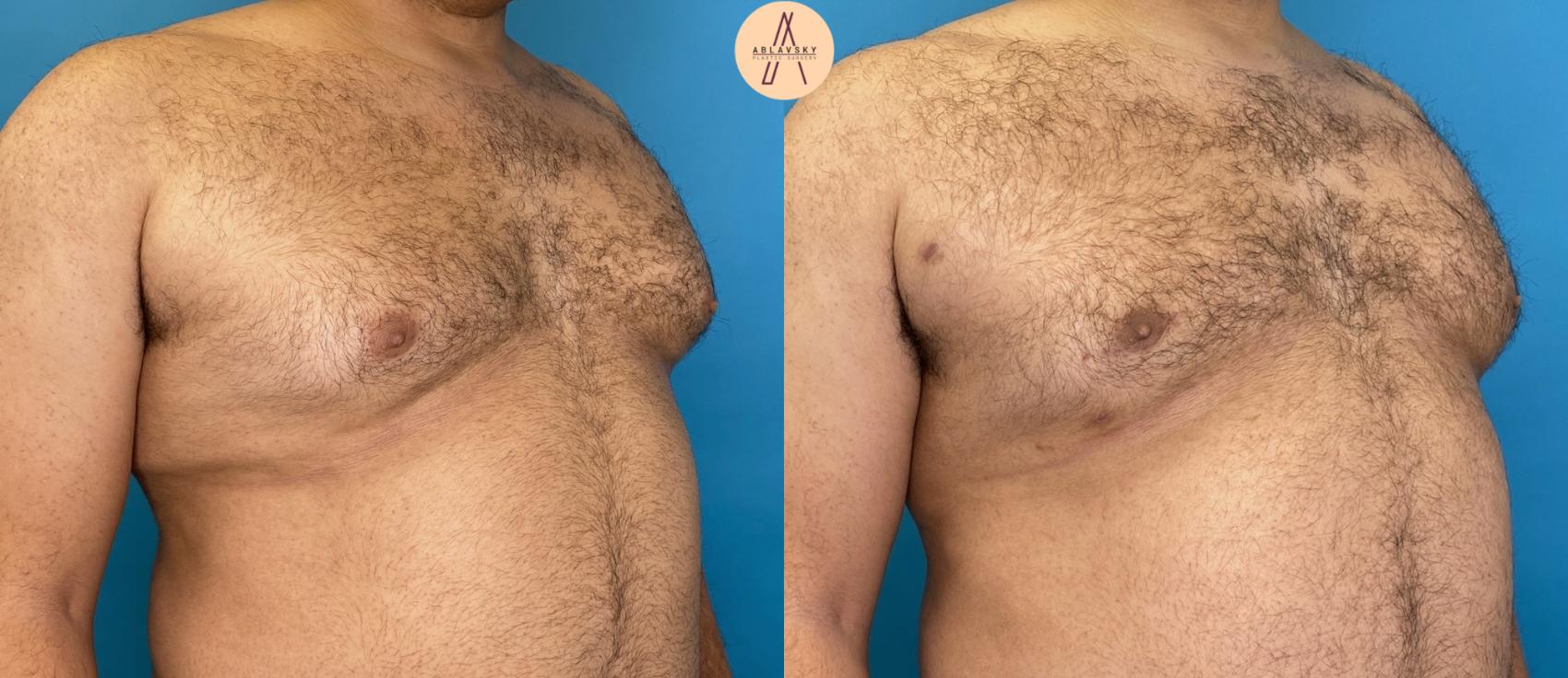 Gynecomastia San Antonio