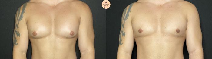 Before & After Gynecomastia Surgery Case 140 Front View in San Antonio, Texas