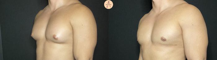Before & After Gynecomastia Surgery Case 140 Left Oblique View in San Antonio, Texas