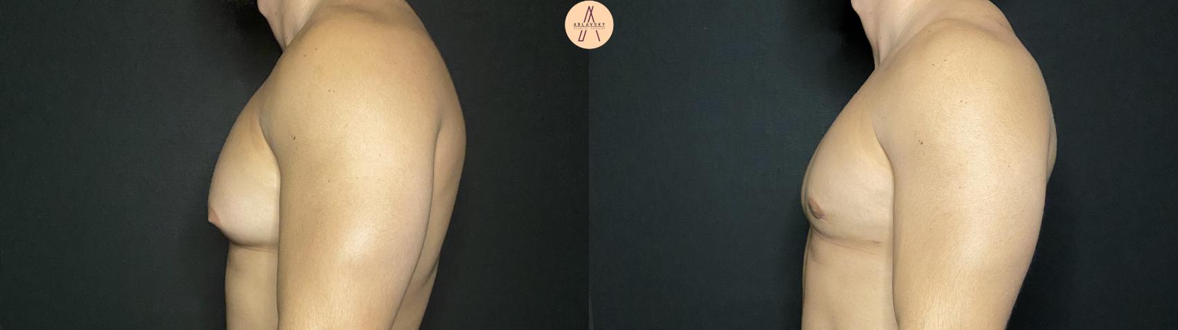 Before & After Liposuction Case 140 Left Side View in San Antonio, Texas