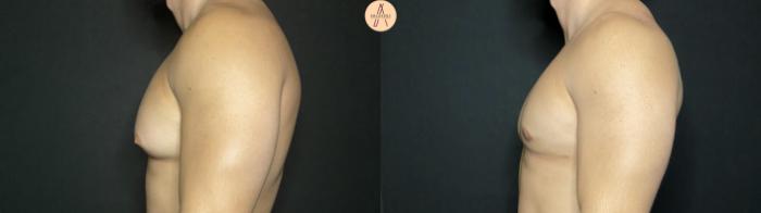 Before & After Gynecomastia Surgery Case 140 Left Side View in San Antonio, Texas