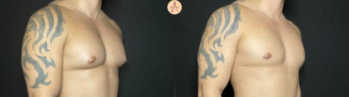 Before & After Gynecomastia Surgery Case 140 Right Oblique View in San Antonio, Texas