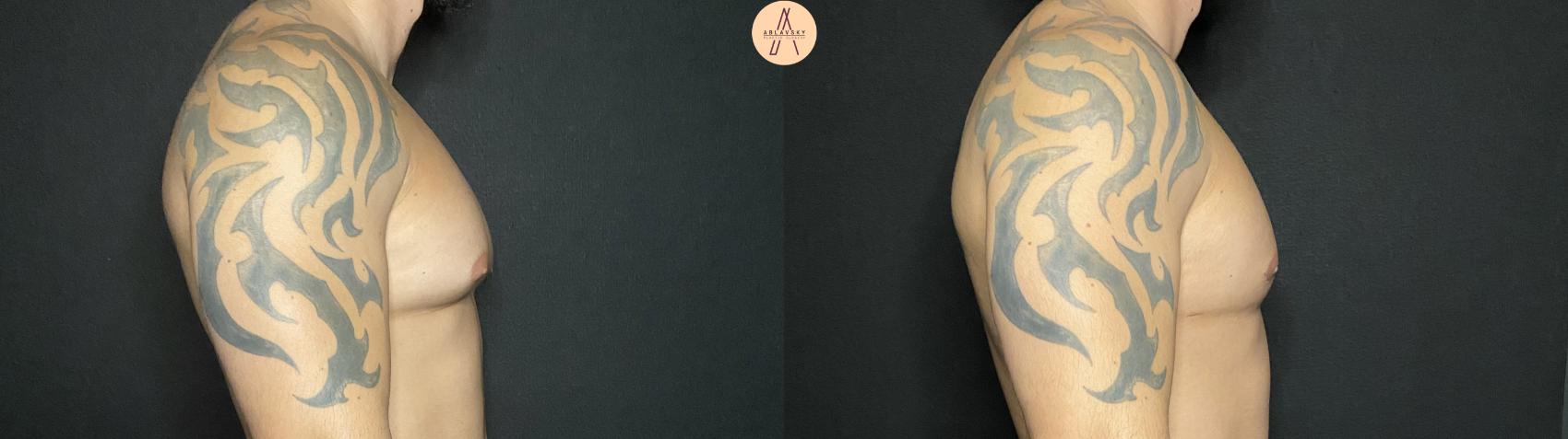 Before & After Liposuction Case 140 Right Side View in San Antonio, Texas