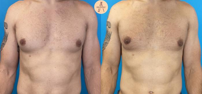 Before & After Gynecomastia Surgery Case 17 Front View in San Antonio, Texas