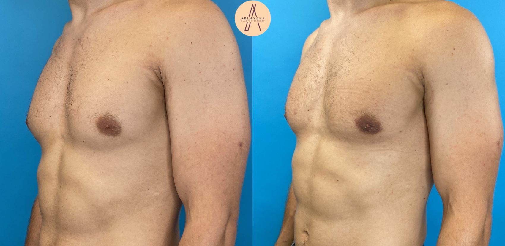 Before & After Gynecomastia Surgery Case 17 Left Oblique View in San Antonio, Texas