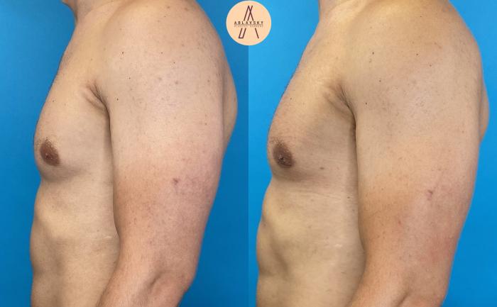 Before & After Gynecomastia Surgery Case 17 Left Side View in San Antonio, Texas