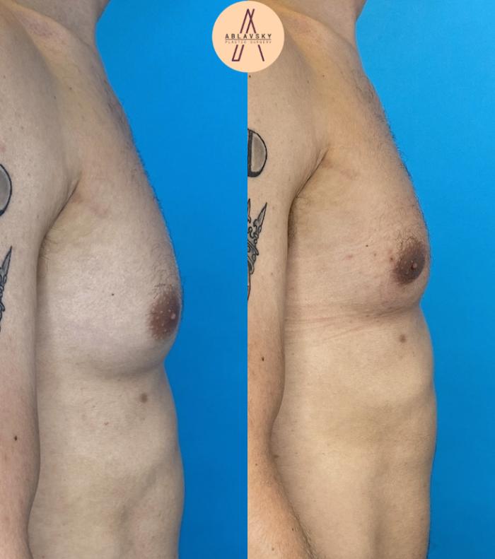 Before & After Gynecomastia Surgery Case 17 Right Side View in San Antonio, Texas