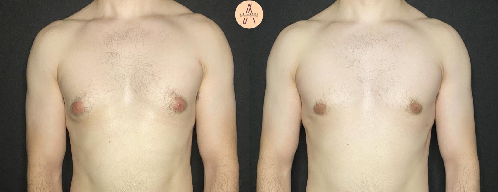 Before & After Gynecomastia Surgery Case 177 Front View in San Antonio, Texas