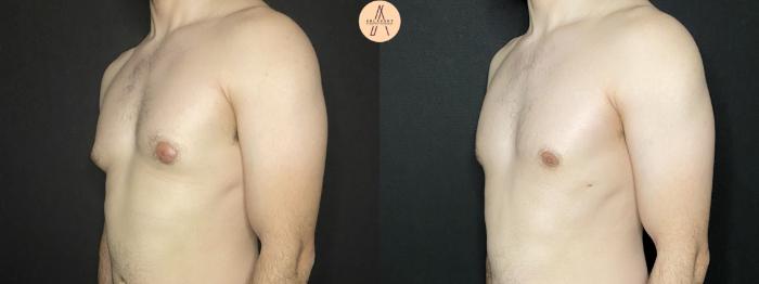 Before & After Liposuction Case 177 Left Oblique View in San Antonio, Texas