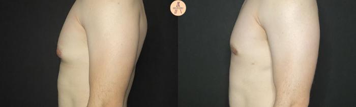 Before & After Liposuction Case 177 Left Side View in San Antonio, Texas