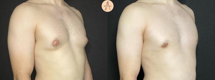 Before & After Gynecomastia Surgery Case 177 Right Oblique View in San Antonio, Texas