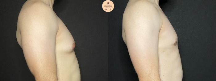 Before & After Gynecomastia Surgery Case 177 Right Side View in San Antonio, Texas