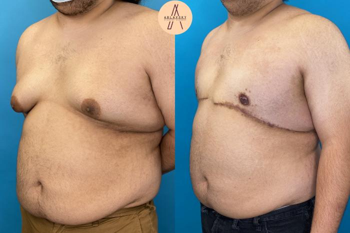Before & After Gynecomastia Surgery Case 22 Left Oblique View in San Antonio, Texas