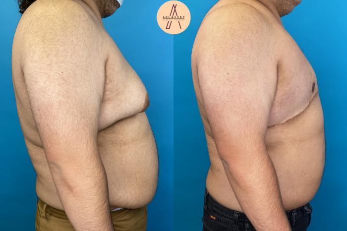 Before & After Gynecomastia Surgery Case 22 Right Side View in San Antonio, Texas