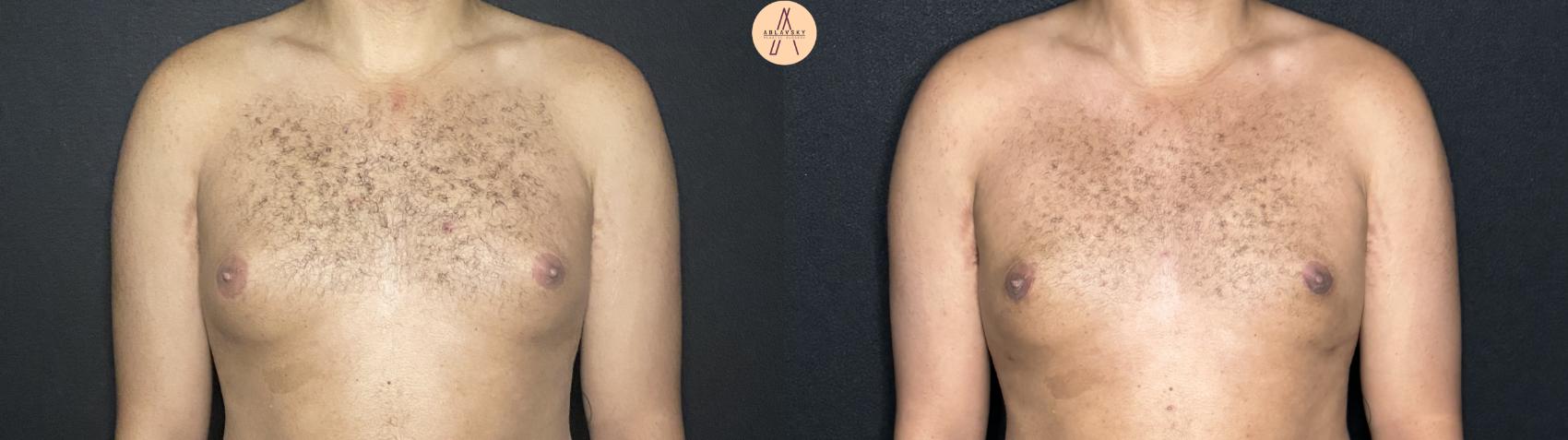 Before & After Gynecomastia Surgery Case 267 Front View in San Antonio, Texas