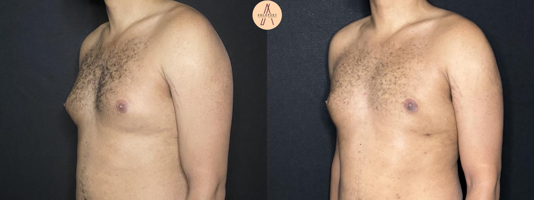 Before & After Liposuction Case 267 Left Oblique View in San Antonio, Texas