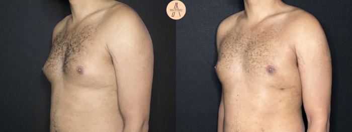 Before & After Gynecomastia Surgery Case 267 Left Oblique View in San Antonio, Texas