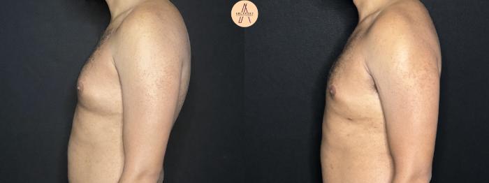 Before & After Gynecomastia Surgery Case 267 Left Side View in San Antonio, Texas