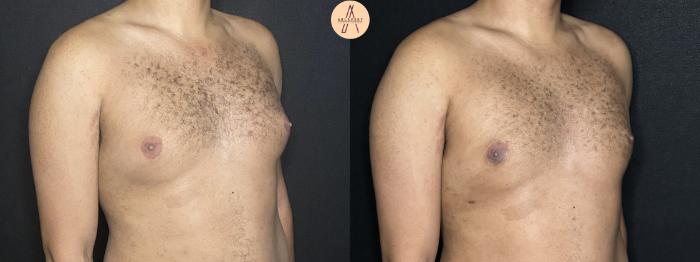 Before & After Gynecomastia Surgery Case 267 Right Oblique View in San Antonio, Texas